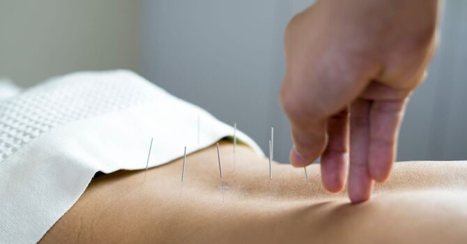 Traditional Acupuncture